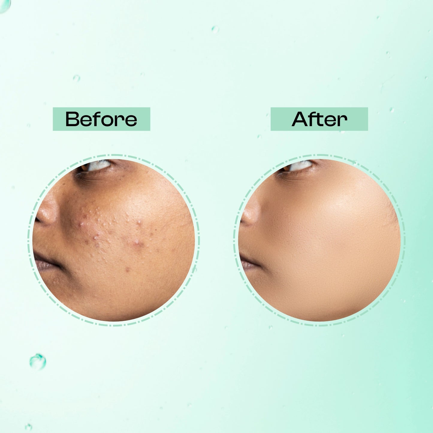 Lelys Acne Censor Gel – Acne Removal Gel, Spot Treatment Gel For Pimple Free Skin | Anti-Acne Gel