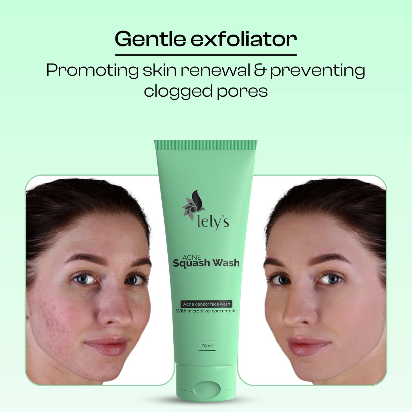Lelys Acne Squash FaceWash - 70 ml