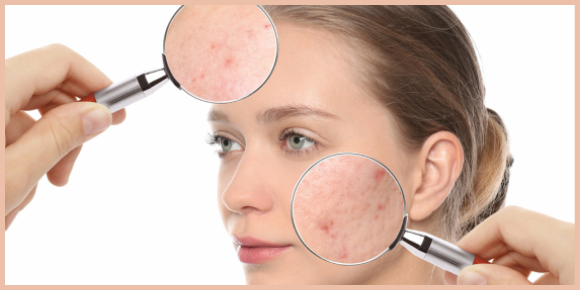 Acne Pigmentation – Here’s Everything You Need to Know About