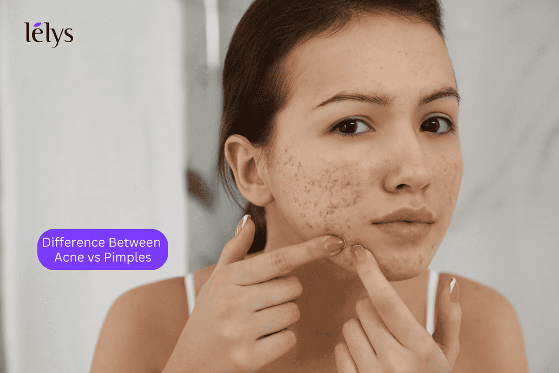 What is The Real Difference Between Acne vs Pimples?