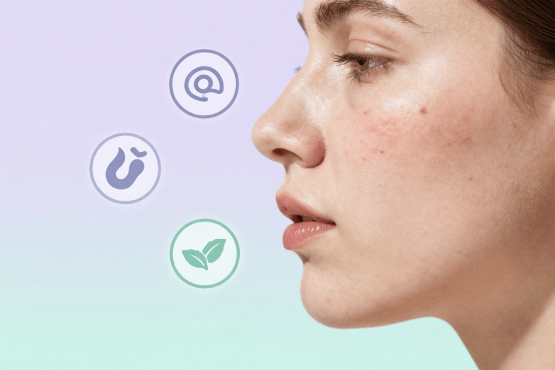 Why Does Acne Keep Coming Back? Causes, Triggers & How to Stop Recurring Breakouts
