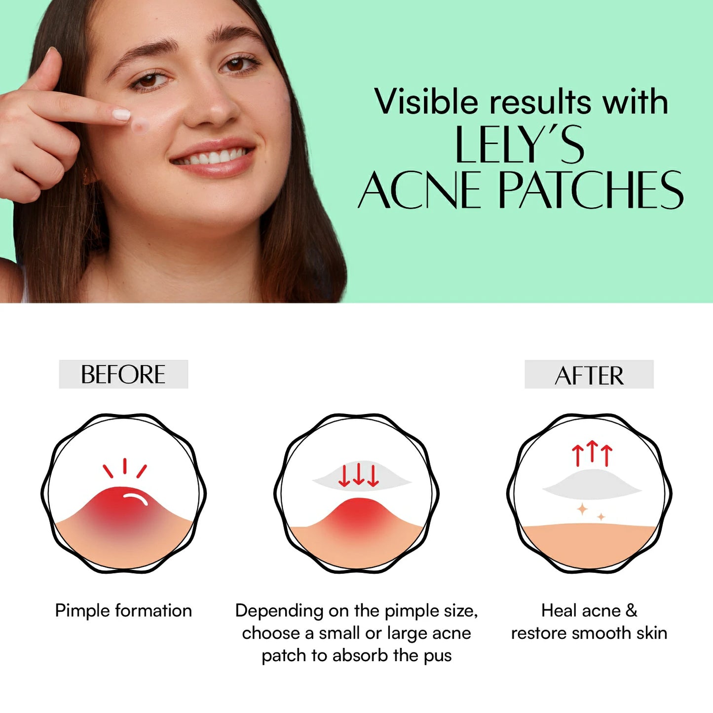 Lelys Acne Patches– 72 Hydrocolloid Acne Patches | Non-comedogenic | Waterproof, Breathable, Affordable Acne Patches