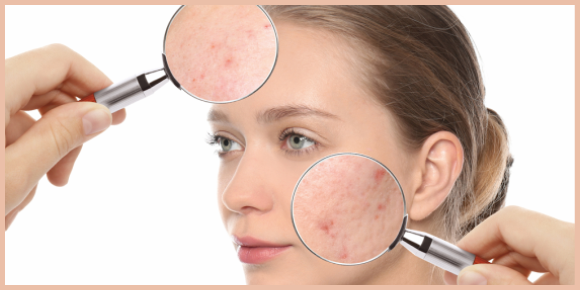 Acne Pigmentation - Here's Everything You Need To Know About