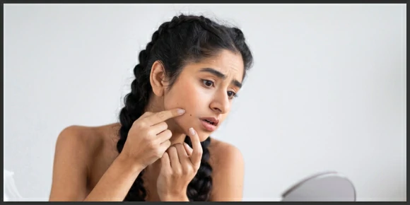 Effective skincare for acne-prone skin